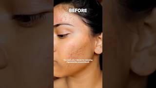 Get Rid of Pimples Overnight! ‍#skincareroutines #skincaretips