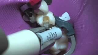 Palodent Plus Matrix System- Contact Creation | Dentsply Sirona