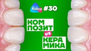 Композит VS Керамика | Дентал Кейсы от BG #30