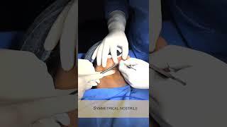 Nostril Reduction Surgery in New Delhi by Dr. Adarsh Tripathi #nosecorrection #cosmeticsurgery #nose