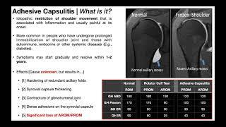 Adhesive Capsulitis (Frozen Shoulder) | Part 1 - Presentation & Pathophysiology