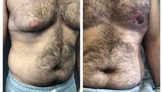 Severe gynecomastia surgery