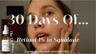 I Used The Ordinary 1% Retinol in Squalane For 30 Days | Acne Scarring Before and After