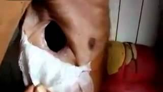 Unsuccessful surgery - old man with hole in his body