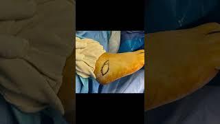 DESYNDACTYLIZATION SURGERY Graphic Content‼️#shorts