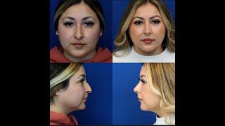 Balanced Rhinoplasty by dr.Ali  Sajjadian|Nose Job before & after!