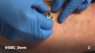 Mole Removal in 4 easy steps