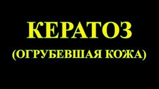 Кератоз – совершенно непростая вещь.