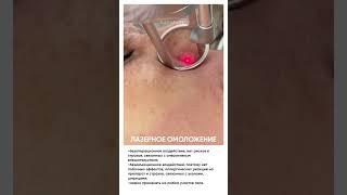 Лазерное омоложение #косметология #лазерноеомоложение