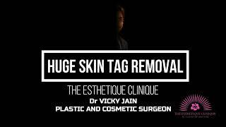 PEDUNCULATED FIBROLIPOMA |BIG SKIN TAG REMOVAL |DR VICKY JAIN |PLASTIC AND COSMETIC SURGEON | LIPOMA