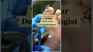 Worried about wart ? |Cutis Hospital Bangalore | Wart Treatment |Skin Care| Electrosurgery for warts