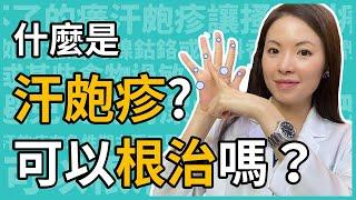 什麼是汗皰疹？如何治療與預防？可以根治嗎？讓調皮女醫林昀萱醫師一次告訴你！