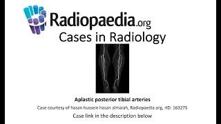 Aplastic posterior tibial arteries (Radiopaedia.org) Cases in Radiology