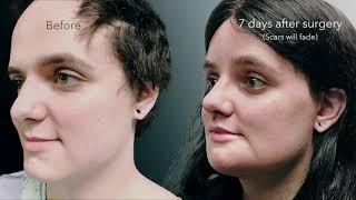 Facial Feminization Surgery | realdrseattle