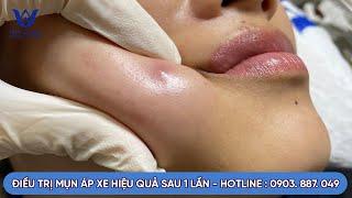 ĐIỀU TRỊ MỤN ÁP XE HIỆU QUẢ SAU 1 BUỔI KHÔNG TÁI LẠI, TẠI PHÒNG KHÁM DA LIỄU HHV CLINIC.