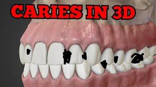 classification of dental caries|G.V black's classification of dental caries|classes of dental caries