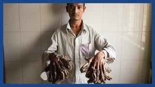 'Tree man’ Abul Bajandar set for life-changing surgery in Bangladesh