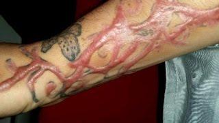 Tattoo-removal procedures leave clients scarred for life