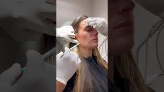 Botox Transformation: Forehead Lines, Frown lines & TMJ