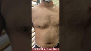 Post Gynecomastia Surgery Scar | Invisible Gynecomastia Surgery Scar | Gynecomastia Surgery Result