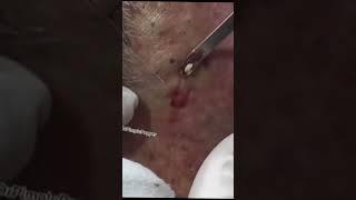 Soothing Blackhead Removal #shorts