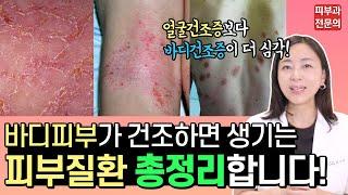 환절기특집) 얼굴피부 건조증보다 바디피부 건조증이 더 위험합니다!!! 바디가 건조하면 생기는 피부질환 총정리! 바디건조증 잡는법 공개