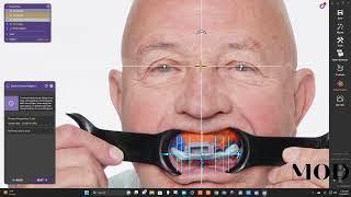 Same day digital denture