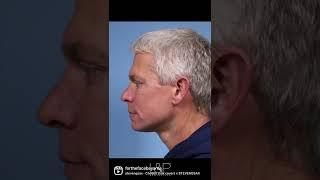 Male Deep Plane Facelift | L&P Aesthetics, the Bay Area's Top Facial Plastic Surgeons