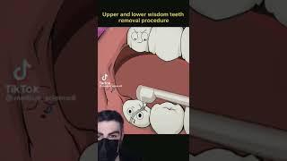 Wisdom Tooth Removal - Animated