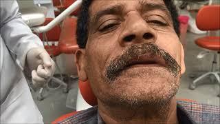 Part I of Bite Registration of completely edentulous patient  ( Adjustment of upper occlusion Block)