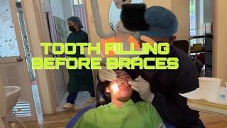 TOOTH FILLING BEFORE BRACES | Liza's Life