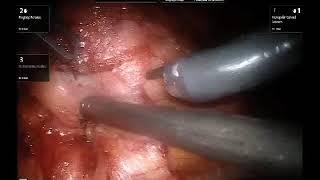 Robotic Assisted Laparoscopic Partial Nephrectomy | Brigham and Women's Hospital