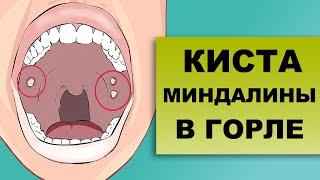 КИСТА МИНДАЛИНЫ В ГОРЛЕ. Причины и лечение