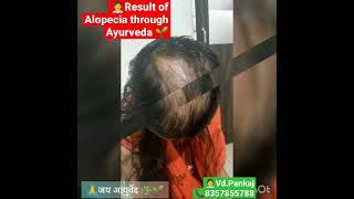 Alopecia treatment #ayurveda #baldness#alopecia #hairfall#hairregroth credit vd.rajneeshalonkar sir