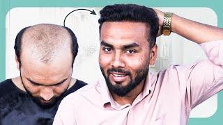 Watch This Amazing 7 Month Hair Transformation  | Hair Transplant in Bangladesh | New Roots