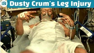 How did Dusty Crum get Scars All Over His Legs? He Almost Lost It in a Car Accident!