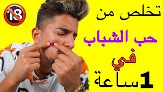 كيف تتخلص من حب الشباب نهائيآ | في المنزل وصفات سحرية