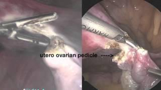 Total laparoscopic vs laparoscopic supracervical hysterectomy