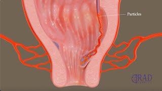 Hemorrhoids Embolization (Embroid)