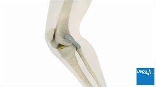 How knee arthroscopy is carried out | Bupa Health