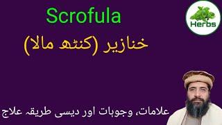 Scrofula | کنٹھ مالا کا علاج | خنازیر کا علاج | Hakeem Zia ur Rehman