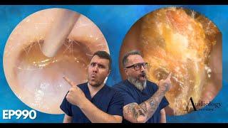 HUGE POLYPS, PEELS & MASSIVE EAR WAX PLUGS - EP990