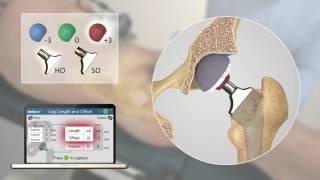 Intellijoint HIP 3D mini-optical navigation tool for THA – Video abstract [ID 119161]