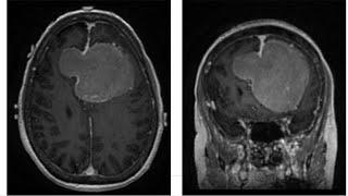 Left frontal craniotomy for resection of a gigantic parafalcine meningioma