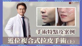 【群英｜#台中拉皮】近位複合式拉皮手術(上)、手術特點及真實案例｜整形外科 #林雍球醫師