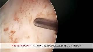 Leading the way in advanced hysteroscopy surgery with optimal results for infertility