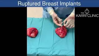 Ruptured breast implants & capsules | Mr Vasu Karri | The Karri Clinic