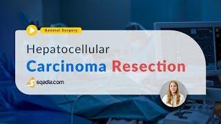 Hepatocellular Carcinoma Resection | Pathology and Cancer Staging Systems | TRAILER