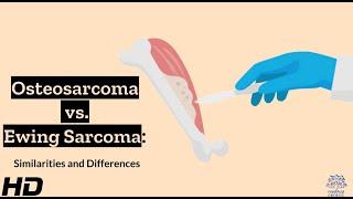 Osteosarcoma vs. Ewing Sarcoma: A Comparative Analysis