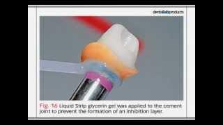 Bench Mastery: Using IPS e.max Press Abutment Solutions for Better Implant Restorations